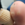 Young teen, 17 years at the time of Needling